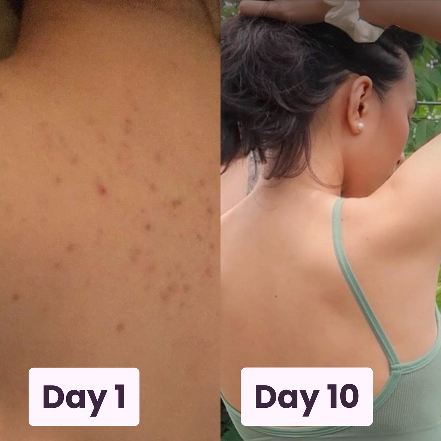 Acne Fighting Body Spray