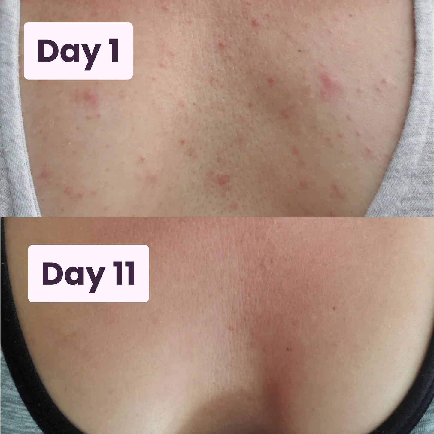 Acne Fighting Body Spray
