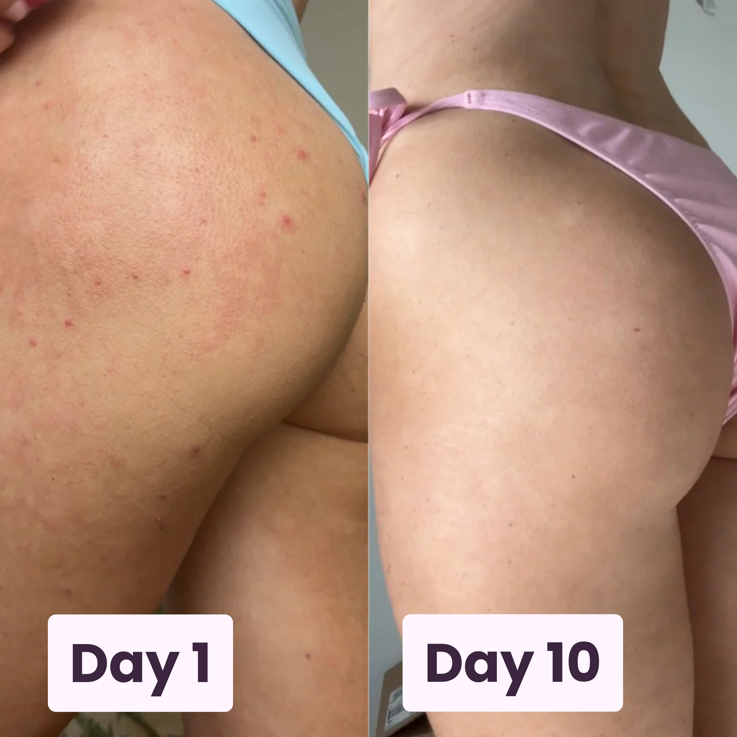 Acne Fighting Body Spray
